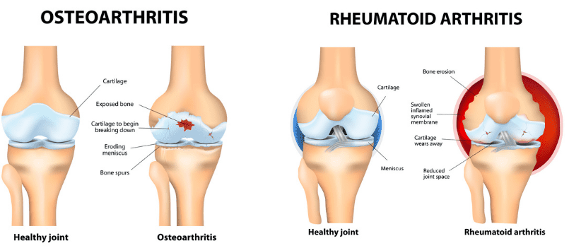 what can you do for joint pain